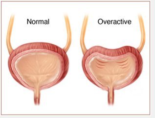 over active bladder